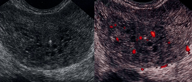 acute prostatitis sa ultrasound