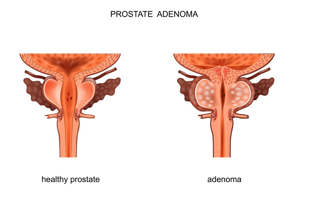himsog nga prostate ug adunay adenoma